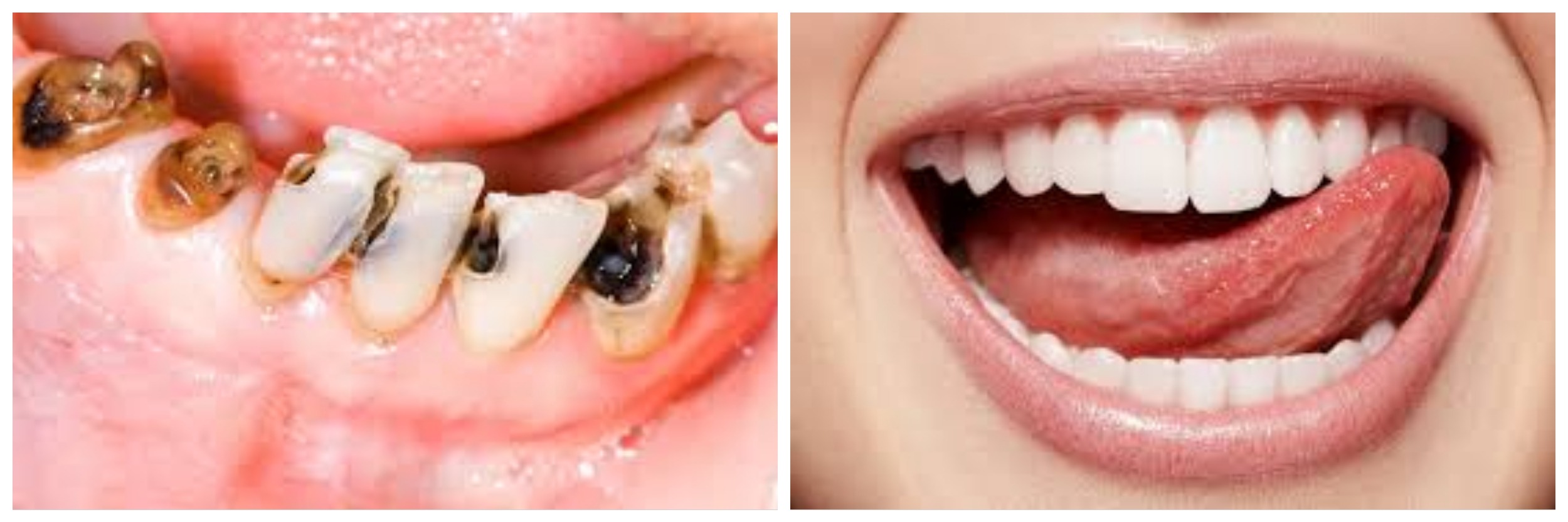Scopri di più sull'articolo PRONTO IL FARMACO CHE FA RICRESCERE I DENTI